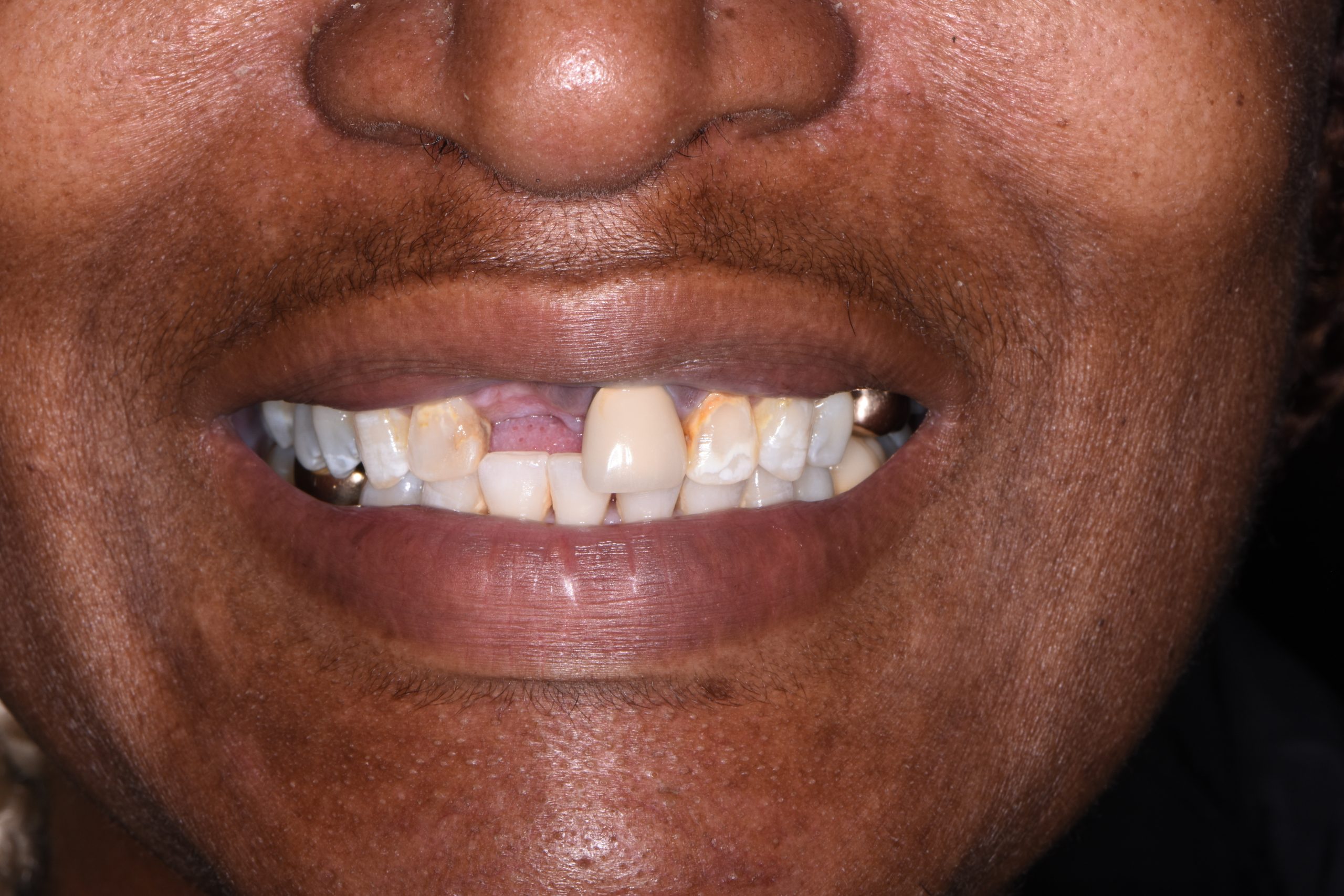 Shantelle before Shantelle before
