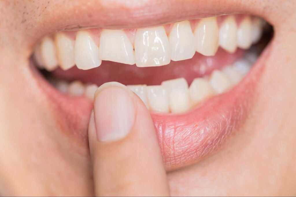 composite bonding Birmingham